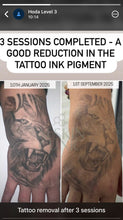 Load image into Gallery viewer, Tattoo Removal
