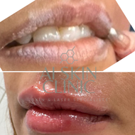 Bio Natural Filler