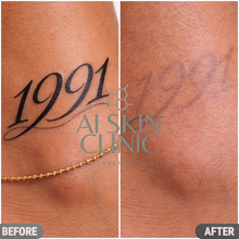 Load image into Gallery viewer, Tattoo Removal
