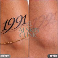 Tattoo Removal