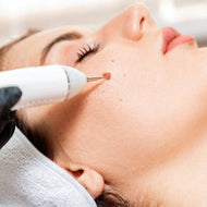Small Mole Removal