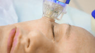 Face RF Micro-needling